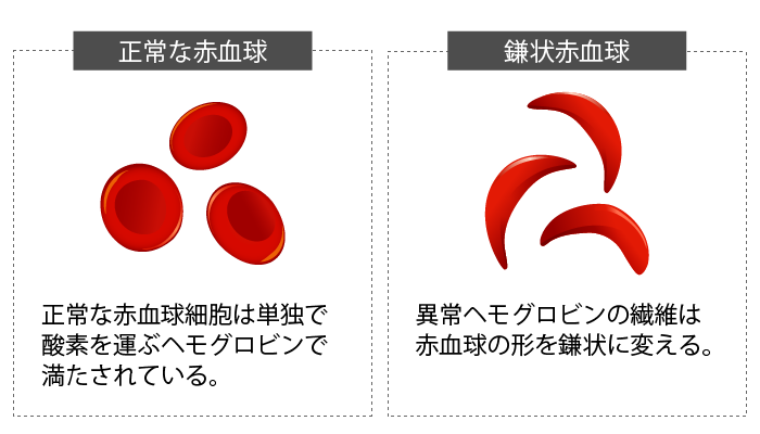 有性生殖⑤鎌状赤血球症とマラリア